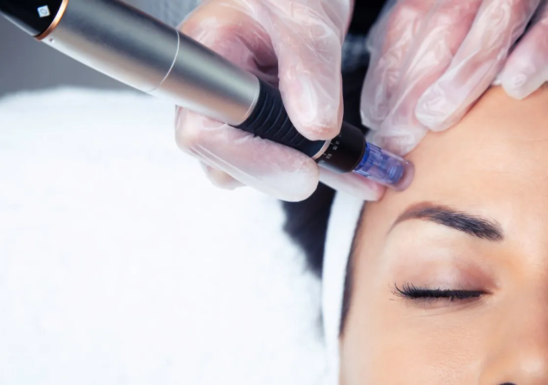 Microneedling treatment with a microneedling pen